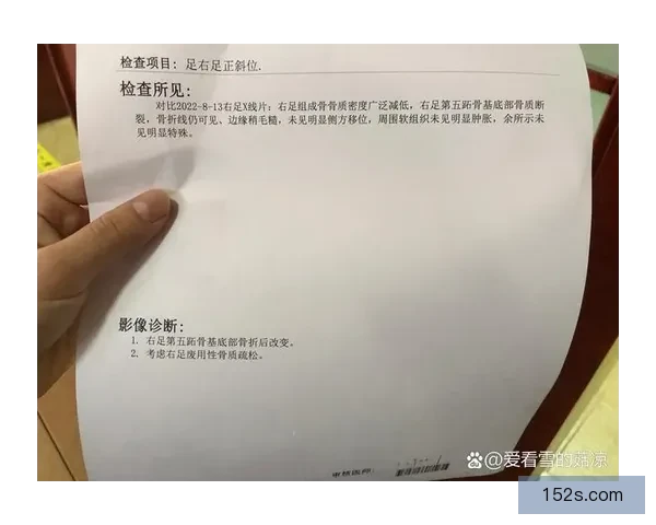 于米提跖骨骨折康复八至十二周